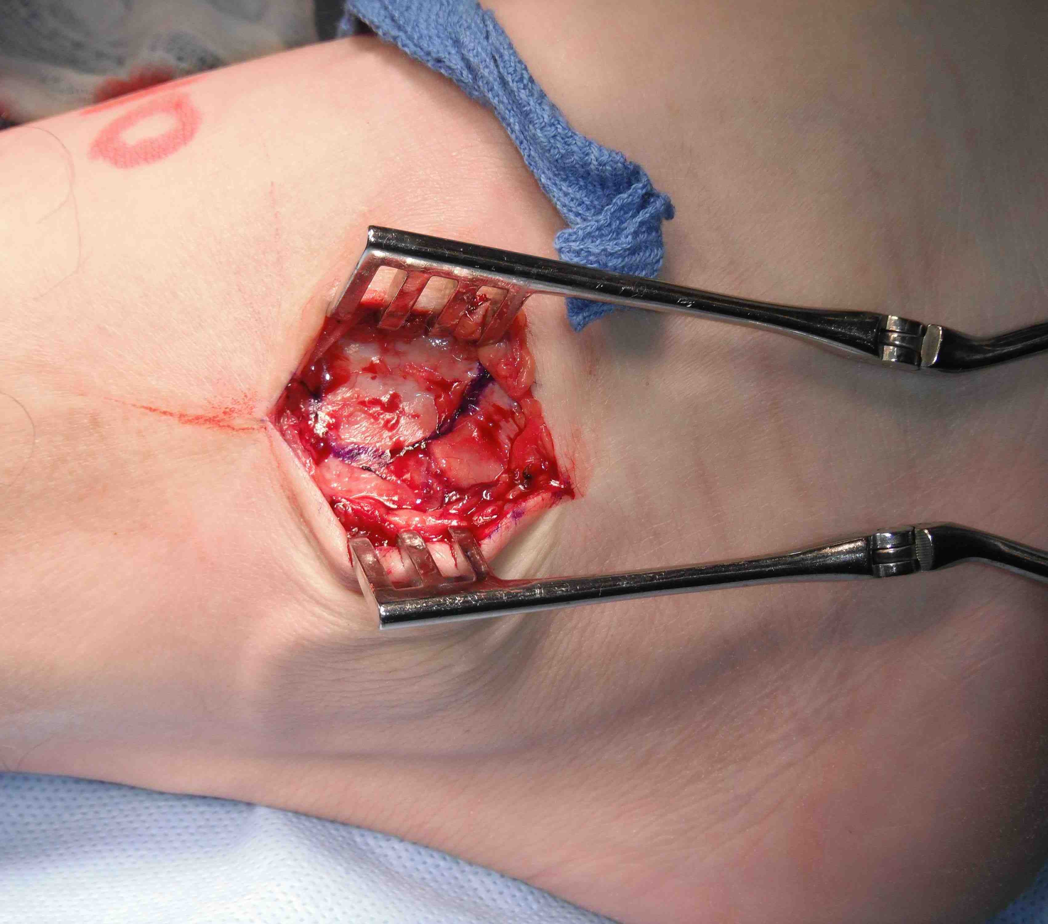 Lateral Ligament Repair Flap Incisions